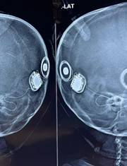 Bilateral (both ears) Cochlear Implantation or Bionic Ear Surgery Bilateral (both ears) Cochlear Implantation or Bionic Ear Surgery